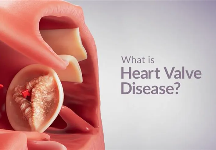 Video thumbnail: WHAT IS HEART VALVE DISEASE